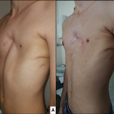 Poland Syndrome With Left Pectoralis Major Muscle Aplasia