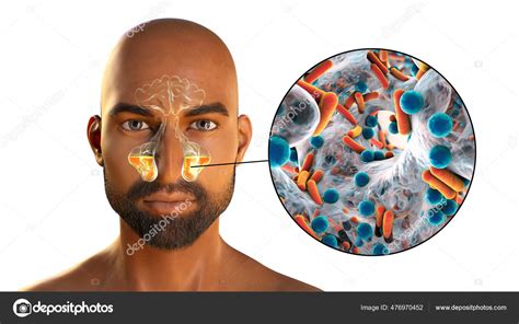 Sinusitis Peradangan Rongga Paranasal Ilustrasi Menunjukkan Peradangan