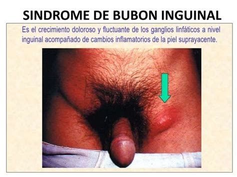 Sindrome De Ulcera Genital Ppt