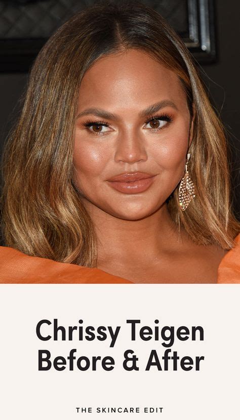 Chrissy Teigen Before And After In 2020 Chrissy Teigen Botox