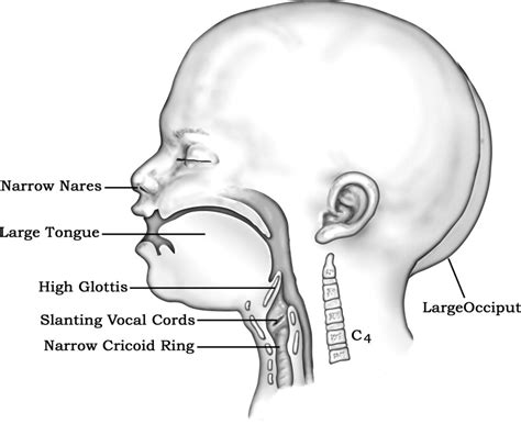 Management Of The Difficult Airway In The Pediatric Patient Operative