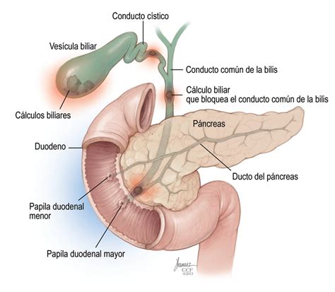 Goly El Julni Suradam Calculo De La Vesicula Biliar Con Colecistitis