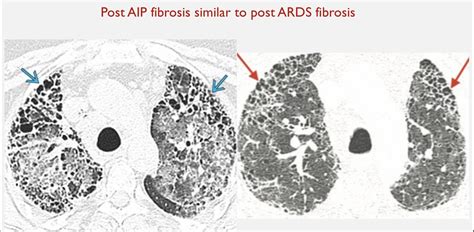 Dr Khaled Ahmed Abuzeid On Twitter Association Of Fibrosis Reticular