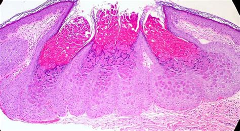 Molusco Contagioso Que Es Y Como Eliminarlo Síntomas Y Tratamientos