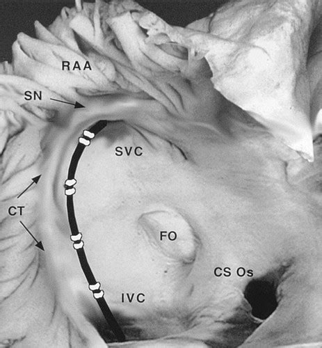 Radiofrequency Catheter Modification Of Sinus Pacemaker Function Guided