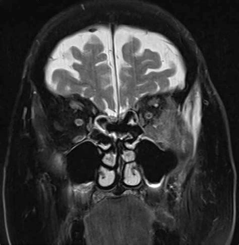 Figure 1 From Sphenopalatine Ganglion Blocks In The Management Of Head And Neck Cancer Related