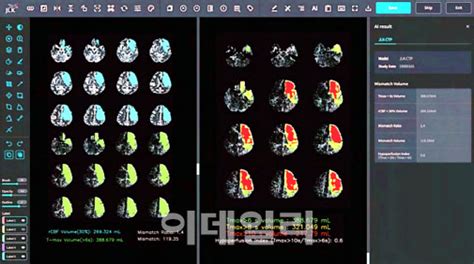 단독 제이엘케이 두번째 Ai 뇌 질환 진단 솔루션 Fda 승인美 레피드ai 제쳤다