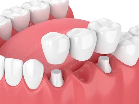 Bridges Crowns Or Implants Which Is Best Naenae Dental Clinic