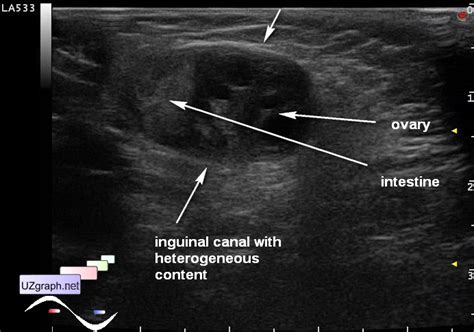 Inguinal Hernia Female Ultrasound