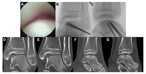 Osteochondral Lesion Of The Talus