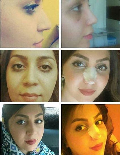 Persian Iranian Rhinoplasty Patients 4 Rhinoplasty Cost Pics