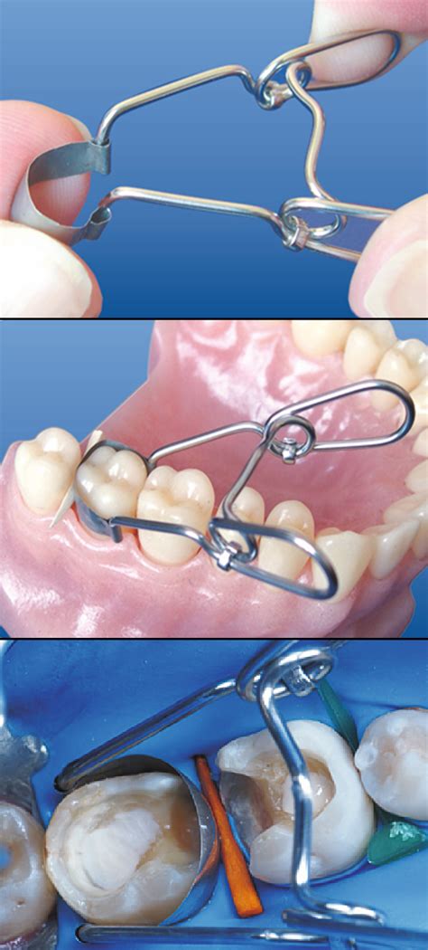 Saddle Contoured Metal Matrices Universal Kit For Premolars Mm