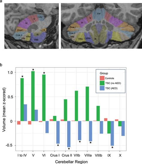 Regionally Specific Tsc1 And Tsc2 Gene Expression In Tuberous Sclerosis