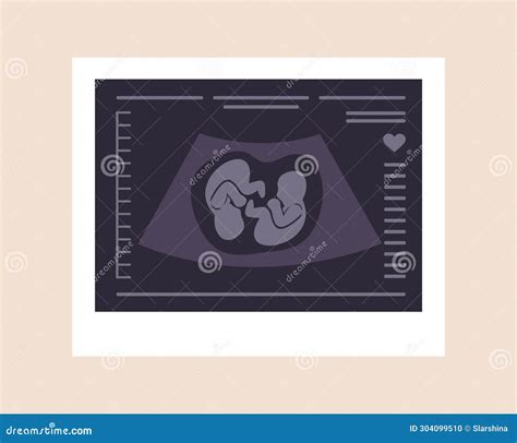 Ultrasound Of Twins Embryos In Womb Pregnancy Screening Babies