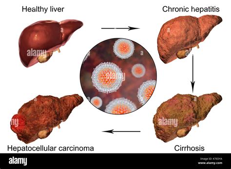 Human Liver Showing Stages Of Liver Disease During Hepatitis C Viral