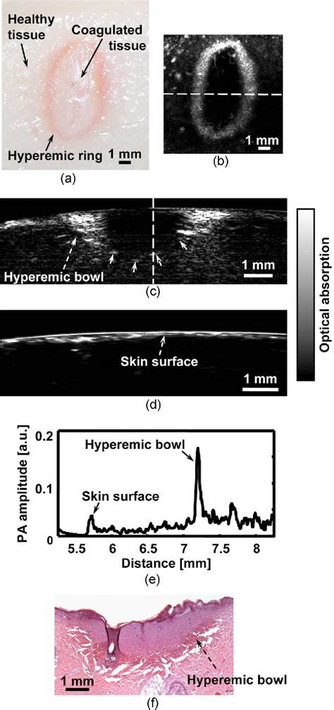 [pdf] Imaging Acute Thermal Burns By Photoacoustic Microscopy Semantic Scholar