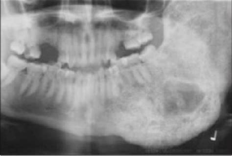 Monostotic Fibrous Dysplasia