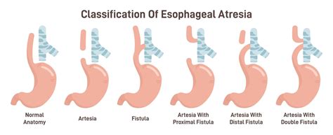 Esophageal Atresia Illustrated Nursing
