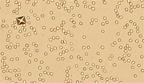 Urinalysis Flashcards Quizlet