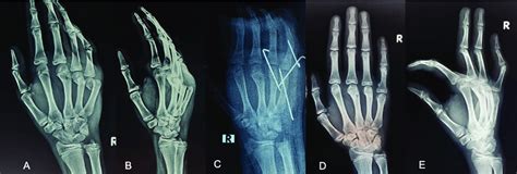 A B Anteroposterior And Oblique Radiographs Of The Affected Hand