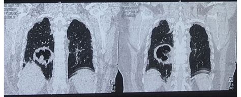 High Resolution Ct Lung Showing Multifocal Fibrotic Changes