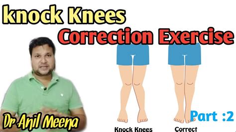 Knock Knee Correction Exercise Knock Knee Problem Solution Knock