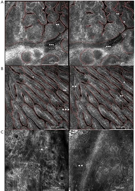 In Vivo Rcm Images Confocal Microscope Image Bcc Frontal First Image