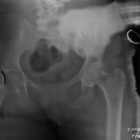 Ap Pelvis Of Right Sided Subcapital Femoral Neck Fracture Taken In The