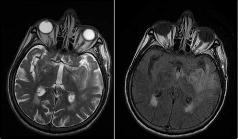 ACCIDENTE CEREBROVASCULAR ISQUÉMICO AGUDO PRINCIPIOS BÁSICOS archivos