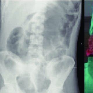 X-ray and surgical specimen of toxic megacolon reports. There are more ...