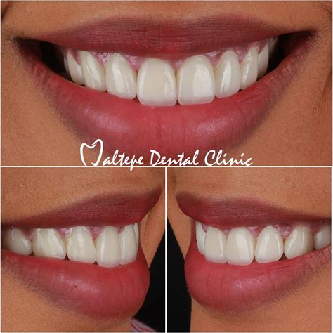 A Perfect Smile With Emax Veneers Dental Clinic Dental Cosmetic Dentist