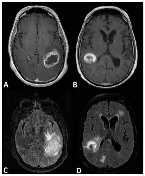 Differentiating Glioblastomas From Solitary Brain Metastases An Update