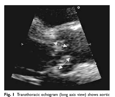 Figure I From Aortic And Mitral Valve Endocarditis Caused By Gemella