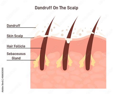 Dandruff Skin Flakes On Itchy And Dry Scalp Cross Section Of Skin