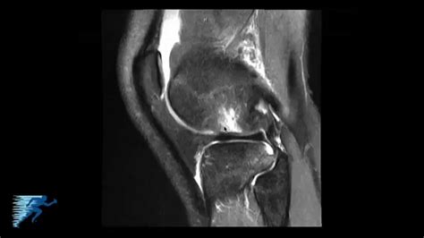 How To Read Knee Mri Of Acl Tear Anterior Cruciate Ligament Injury