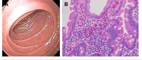 Figure From Gastroenterology Clinics Of North America Eosinophilic