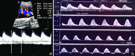 (a) Normal umbilical artery Doppler. (b) Umbilical artery Doppler... | Download Scientific Diagram