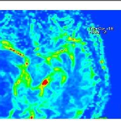 A 60-year-old female. Heterogeneously enhancing mass in the left ...