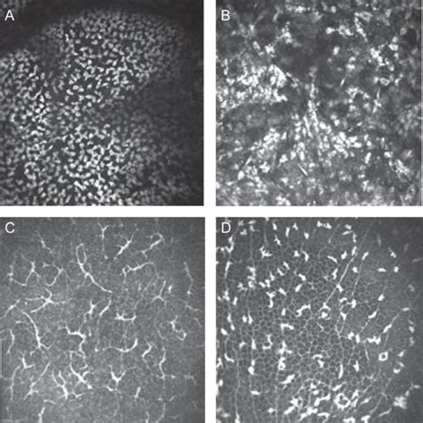 A B In Vivo Confocal Image Of A Patient With Acute Fungal Keratitis