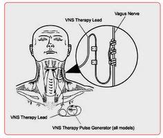 1000+ images about Vagus nerve stimulation. VNS on Pinterest | Vagus ...