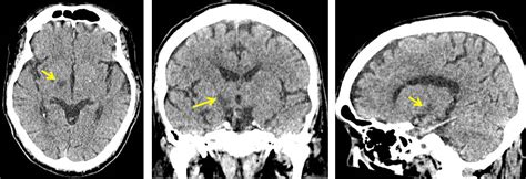 Hemiballismus caused by subthalamic infarction – Radiology Cases