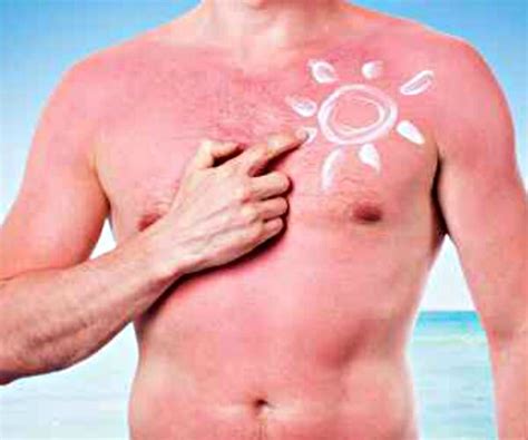 How To Soothe Sunburns Naturally