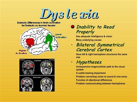 Chapter 14: Lateralization & Language