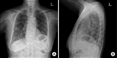 Chest X Rays Showing Diffuse Ground Glass Opacities In The Right Lower Download Scientific