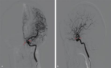 A And B Follow Up Digital Subtracting Angiography Showing Complete