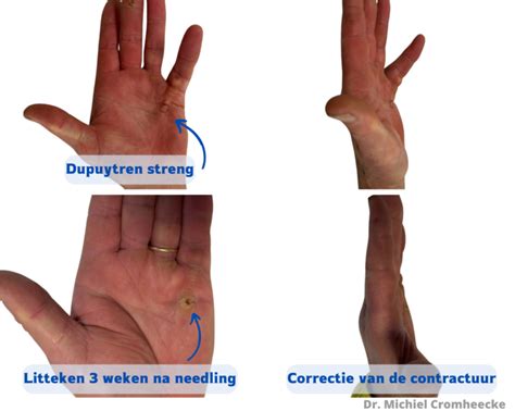 Ziekte Van Dupuytren Dr Michiel Cromheecke