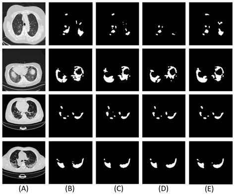 ADID UNETa Segmentation Model For COVID 19 Infection From Lung CT