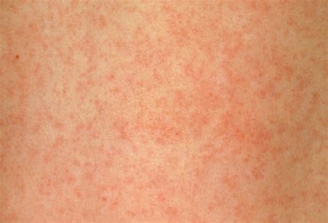 adult rash - pictures, photos