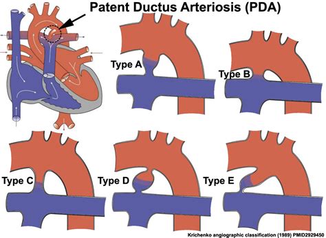 File Patent Ductus Arteriosus Classification  Embryology