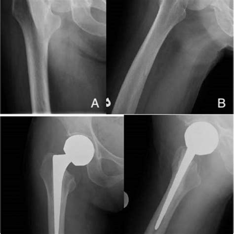 A B Pre Operative X Ray Of Case 1 Anteroposterior And Lateral